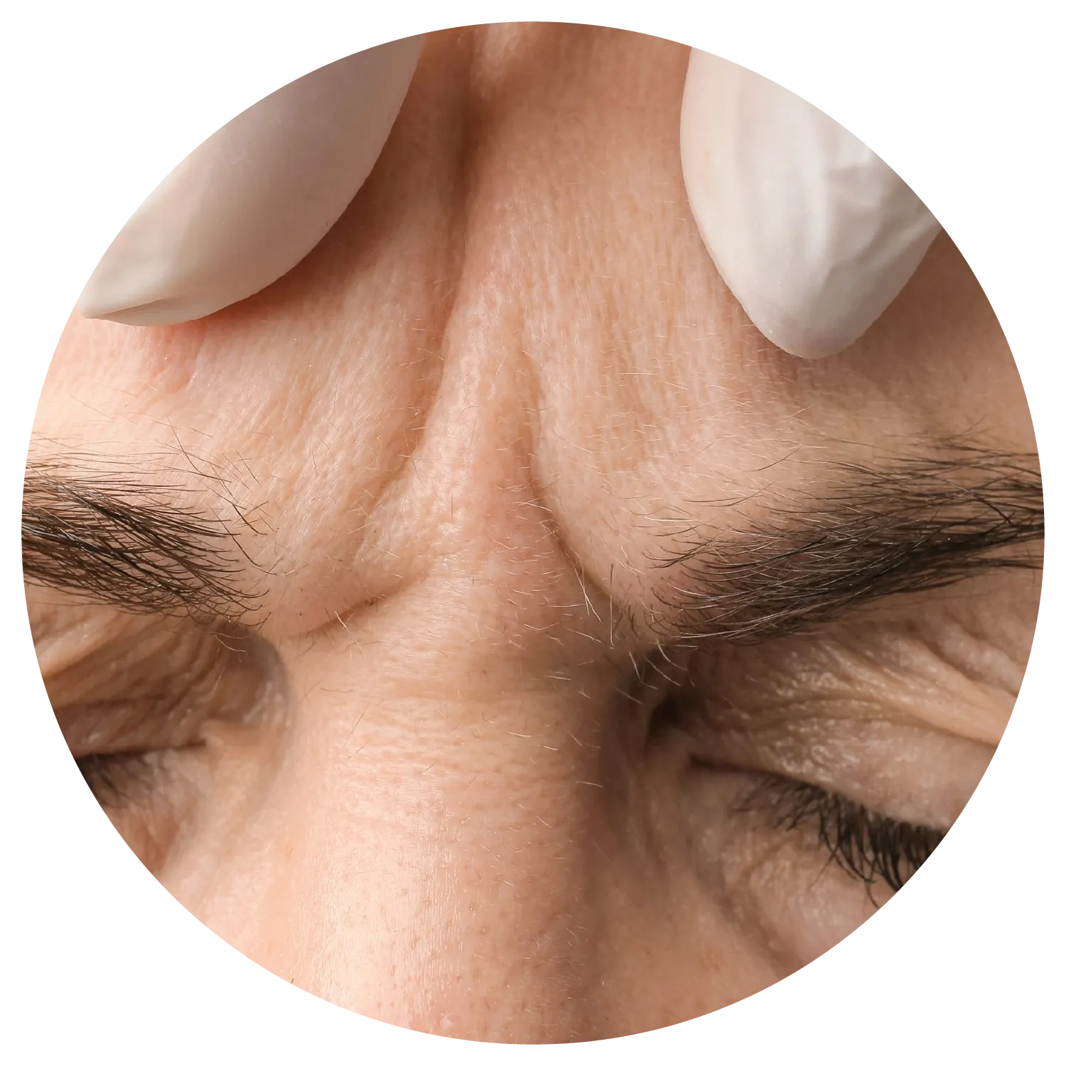Glabellar lines treatment process at Toronto medical spa - root causes and development